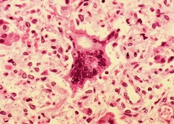 Sarampo atinge o nível mais elevado de casos na Europa em mais de 25 anos