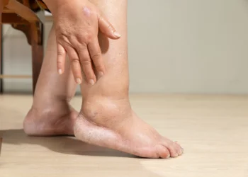 Lipedema: emagrecer é suficiente para controlar a doença?