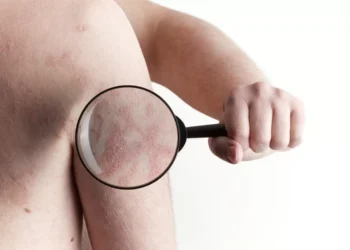 Psoríase: doença na pele pode ser a ponta do iceberg