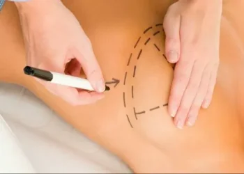 SUS amplia acesso à cirurgia de reconstrução mamária para além dos casos de câncer