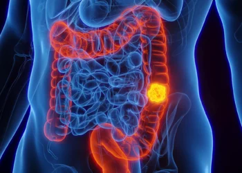 Por que o câncer de intestino em jovens tornou-se preocupação global