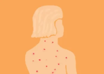 O que levou a região das Américas a perder o certificado de eliminação do sarampo